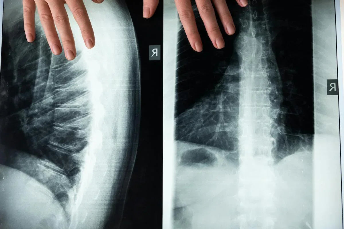 Close-up view of two spinal X-ray images, one side view and one front view, with hands positioned above the scans for examination.