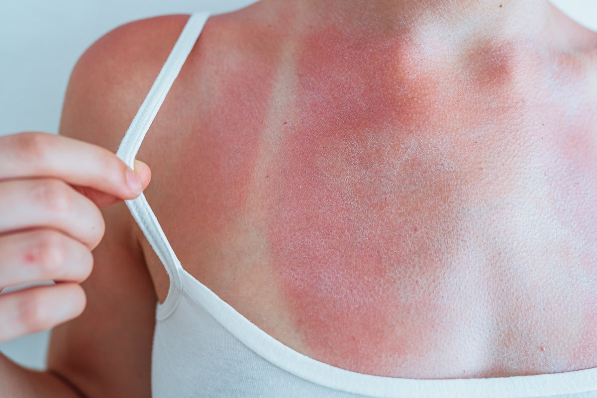 Can Omega-3 Fatty Acids Help Reduce Sunburn Risk?